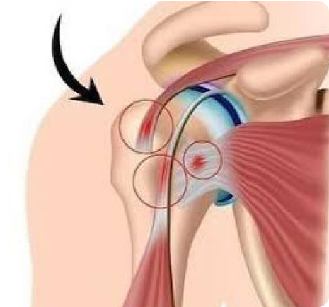 Ombro e Cotovelo - Traumacore - Centro de Traumatologia e Ortopedia