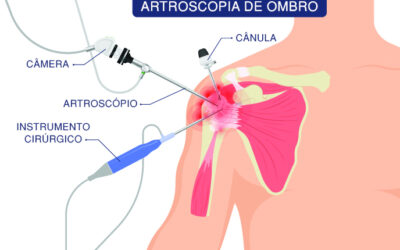 Artroscopia no ombro: entenda como é realizada