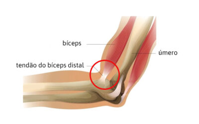 Ruptura e lesão do bíceps distal: conheça a origem desses problemas