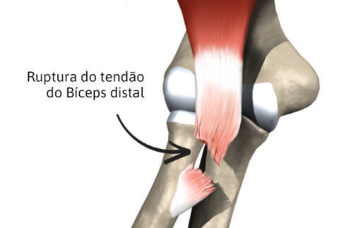 Ruptura E Les O Do B Ceps Distal Conhe A A Origem Desses Problemas